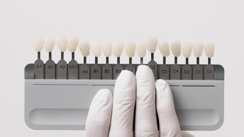 Implantes Dentales: La solución definitiva para recuperar tu sonrisa y tu confianza